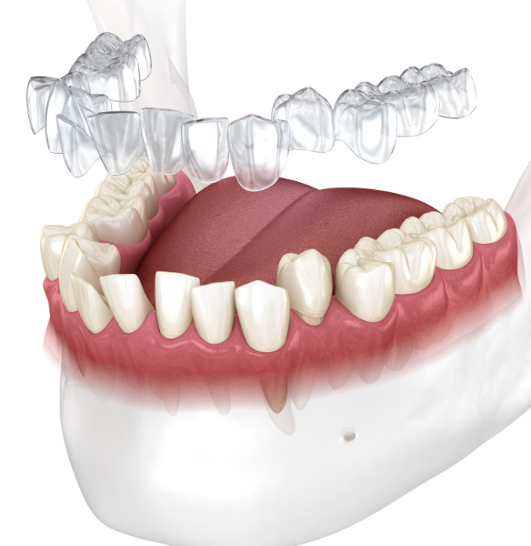Invisalign Smile Correction